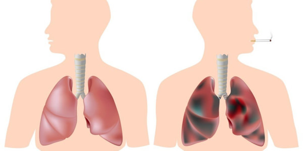 Восстановление легких после отказа от курения