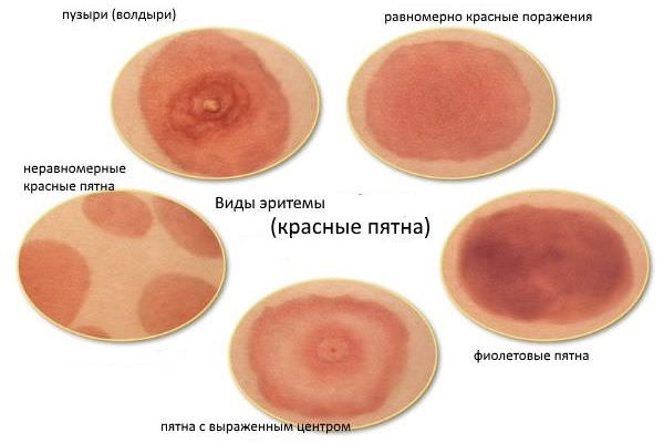 сыпь 1