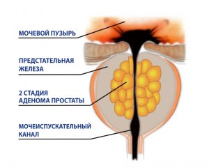 Доброкачественная гиперплазия предстательной железы