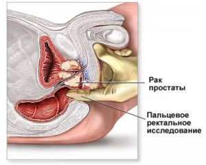 Рак простаты