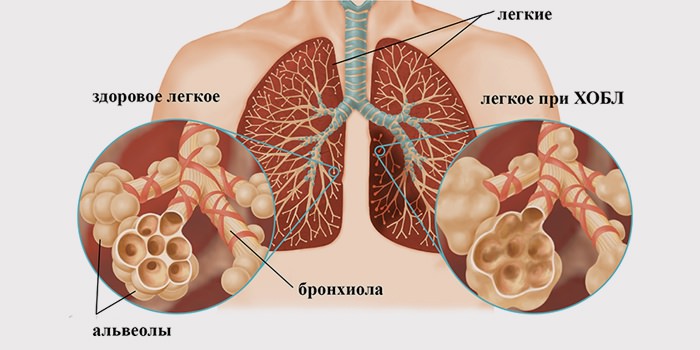 Признаки и симптомы ХОБЛ